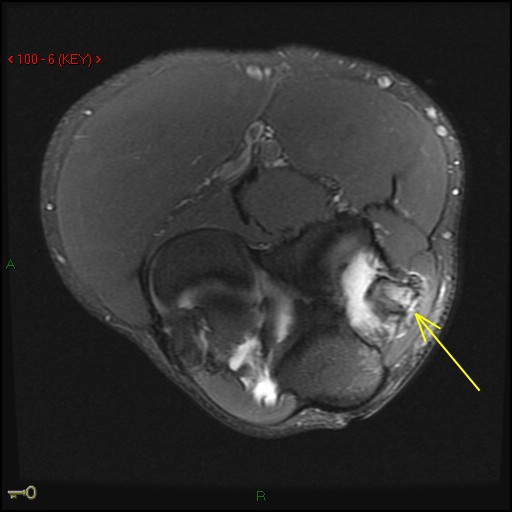 Figure 2 for case Ununited epicondylar fractures